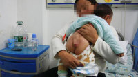 男婴患罕见病屁股长"尾巴"