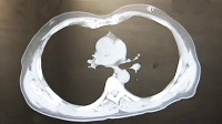 55岁男子被确诊患乳腺癌
