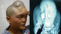 26岁妈妈头顶现"龙角"