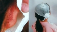 女童遭老师拧耳朵缝十针
